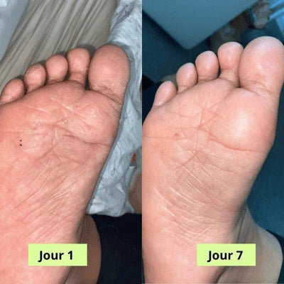 Savon Purifiant PuraPedi™