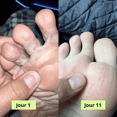 Savon Purifiant PuraPedi™
